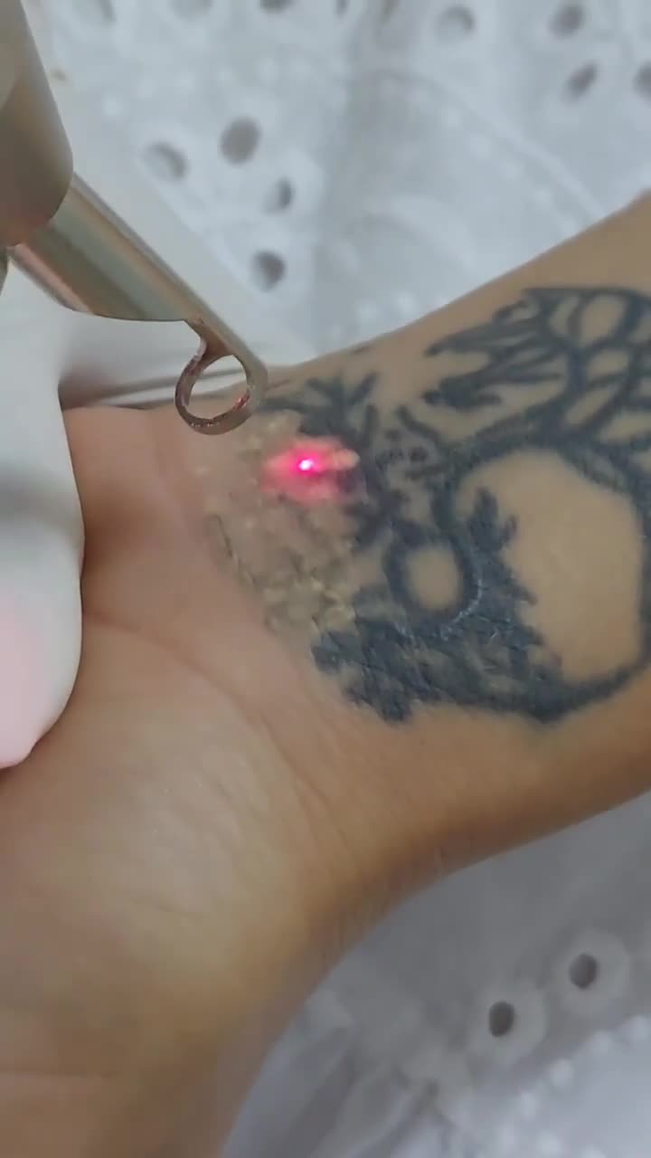 Çapıqların Plexr aparatı ile götürülməsi❤️